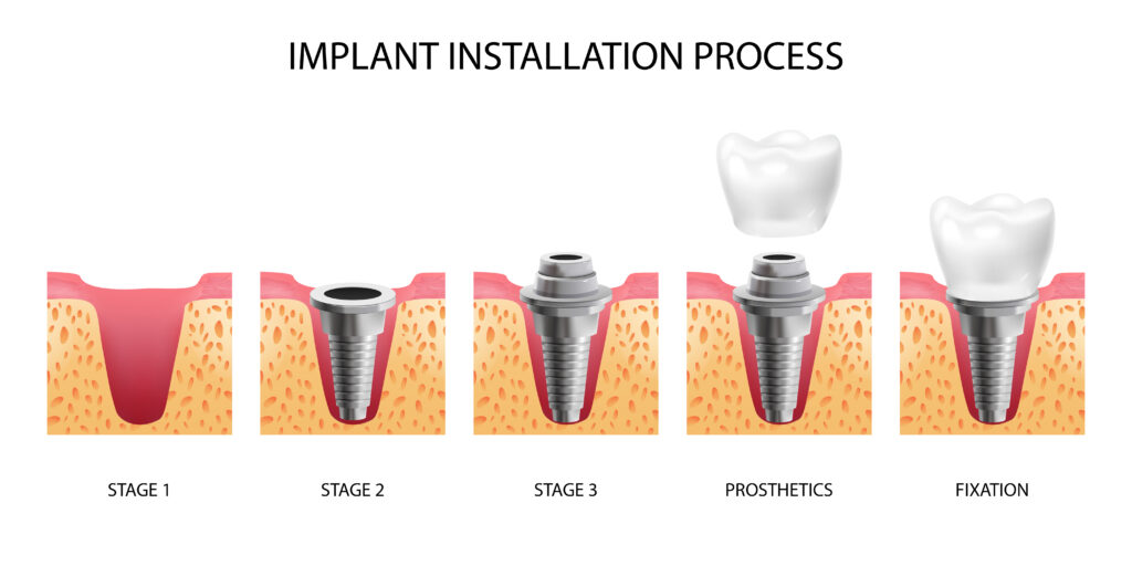 HOW DO DENTAL IMPLANTS WORK - Best 3 stages of dental implants?